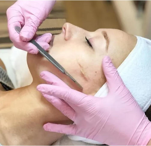 Dermaplaning